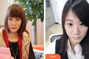 成都嬌點(diǎn)醫(yī)學(xué)美容醫(yī)院張麗梅整形價(jià)格表附祛斑案例展示