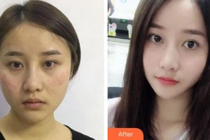 成都艾米麗醫(yī)療美容門診部秦小梅整形價(jià)格表附超激光美膚祛斑案例展示