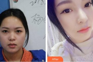 成都華顏醫(yī)療美容門診部胡宇昆整形價(jià)格表附鼻部手術(shù)案例展示