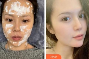 成都春天醫(yī)療美容門診部許麗君整形價(jià)格表附熱瑪吉案例展示