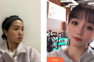 成都美立方（原華博）醫(yī)療美容醫(yī)院楊黎黎整形價(jià)格表附面部案例展示