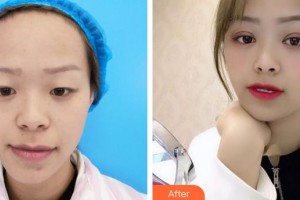 成都明星醫(yī)療美容門診部于海成整形價(jià)格表附眼部手術(shù)案例展示