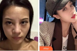 成都黃氏百佳整形醫(yī)院汪秦整形價(jià)格表附隆鼻案例展示