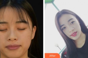 成都唯羅納醫(yī)療美容門診部羅佳整形價(jià)格表附抗衰抗初老案例展示