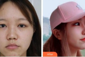 成都景華醫(yī)學(xué)美容門診部江濤整形價(jià)格表附鼻部手術(shù)案例展示