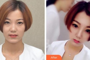 成都明星醫(yī)療美容門診部黃曉光整形價(jià)格表附眼部綜合案例展示