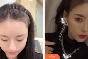 成都景華醫(yī)學(xué)美容門診部楊杰整形價(jià)格表附發(fā)際線案例展示