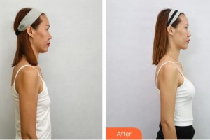 成都瑞美薈醫(yī)療美容醫(yī)院王家勇整形價(jià)格表附假體隆胸案例展示