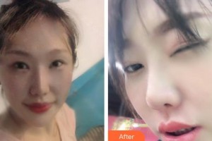 成都明星醫(yī)療美容門診部楊建昌整形價(jià)格表附埋線提升案例展示