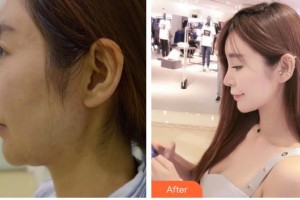 成都美卿醫(yī)療美容醫(yī)院凱恩整形價格表附面部環(huán)吸案例展示