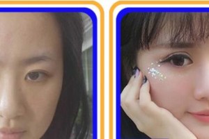 成都如悅醫(yī)療美容醫(yī)院徐進整形價格表附眼部手術(shù)+脂肪案例展示