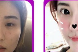 成都江華美整形美容醫(yī)院周棋林整形價格表附眼部綜合案例展示