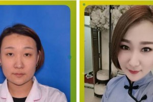成都年輕化社醫(yī)療美容診所張曉鳳老師整形價格表附眼部綜合案例展示
