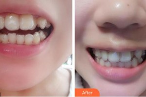 成都唐牙科門診部周麗容整形價格表附牙齒矯正案例展示