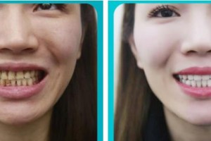 成都華美牙科悅齒門診部田洪君整形價格表附牙齒美白案例展示