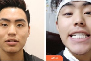 成都瑞泰融誠口腔醫(yī)院劉澤萍整形價格表附牙齒縫隙矯正案例展示