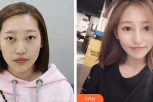 成都西區(qū)醫(yī)院醫(yī)學(xué)美容科鄧東偉整形價格表附埋線雙眼皮+鼻部手術(shù)案例展示