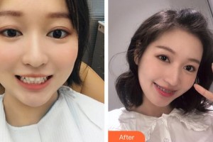 成都全醫(yī)堂中醫(yī)名醫(yī)館門診部梁超整形價格表附牙齒矯正案例展示