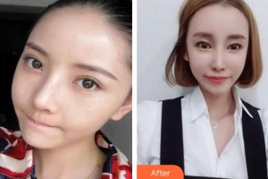 成都潤禾皮膚病?？漆t(yī)院殷明坤整形價格表附祛斑案例展示