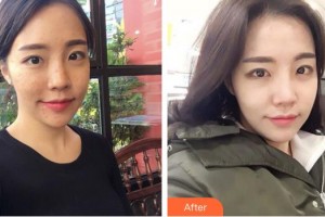 成都潤禾皮膚病?？漆t(yī)院李艷整形價格表附祛痘美膚案例展示