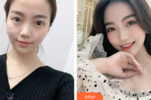 成都新視界眼科醫(yī)院陳燕整形價格表附眼部綜合案例展示