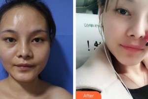 成都綠葉愛麗美婦產(chǎn)科醫(yī)院醫(yī)療美容科何鵬整形價格表附自體脂肪填充案例展示