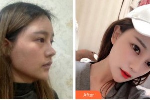 成都百媚生醫(yī)療美容門診部宴國富整形價格表附鼻部手術(shù)案例展示