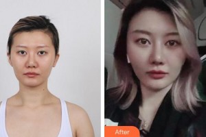 成都友誼醫(yī)院李萍整形價格表附鼻部手術(shù)案例展示