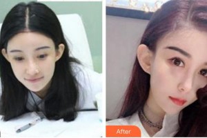 成都瑞麗詩美學(xué)植發(fā)門診部姜印整形價格表附發(fā)際線案例展示