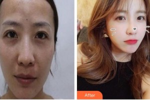 成都中醫(yī)藥大學(xué)附屬醫(yī)院銀海醫(yī)美何軍整形價格表附脂肪填充案例展示