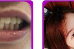 成都茁悅口腔診所胡永整形價格表附牙齒矯正案例展示