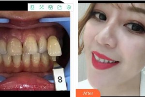 成都茁悅口腔診所張達(dá)良整形價格表附牙綜合案例展示