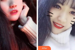 成都康橋眼科醫(yī)院李岷元整形價格表附牙齒美白案例展示