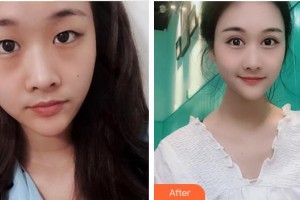 成都愛迪眼科醫(yī)院連浩整形價格表附眼部綜合案例展示