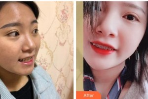 成都茁悅口腔診所馮李娟整形價格表附牙齒矯正案例展示