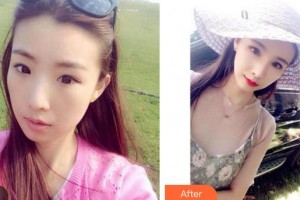 成都愛迪眼科醫(yī)院鄧彥整形價(jià)格表附眼部綜合案例展示