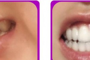 成都茁悅口腔診所楊瑾廷整形價(jià)格表附牙齒矯正案例展示