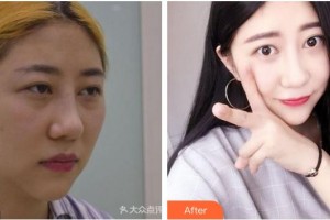 成都愛迪眼科醫(yī)院李綱整形價(jià)格表附雙眼皮案例展示