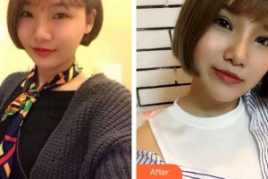 成都愛迪眼科醫(yī)院吳瑛整形價(jià)格表附眼部整形案例展示