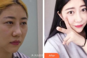 成都愛迪眼科醫(yī)院張軍軍整形價(jià)格表附全切雙眼皮案例展示