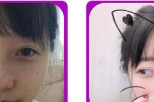 成都愛迪眼科醫(yī)院周波整形價(jià)格表附眼部綜合案例展示