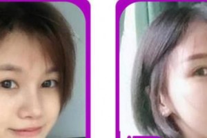 成都愛迪眼科醫(yī)院丁儉整形價(jià)格表附切開雙眼皮案例展示