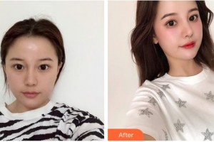 成都愛迪眼科醫(yī)院譚永福整形價(jià)格表附眼部手術(shù)案例展示