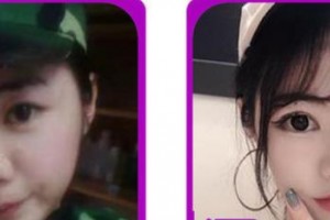 成都愛迪眼科醫(yī)院韋斌整形價(jià)格表附切開雙眼皮案例展示