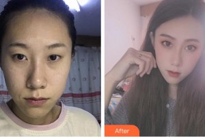 成都愛迪眼科醫(yī)院楊雨昆整形價(jià)格表附眼部手術(shù)案例展示