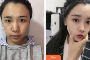 成都世紀(jì)眼科醫(yī)院張潔整形價(jià)格表附眼部綜合案例展示