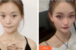 成都市新都區(qū)人民醫(yī)院眼科蔣娛整形價(jià)格表附雙眼皮內(nèi)眼角案例展示