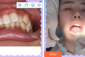 成都佰視達(dá)眼科門診部林文整形價(jià)格表附牙綜合案例展示