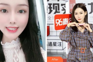 成都華西牙種植醫(yī)院楊小東整形價(jià)格表附牙綜合案例展示