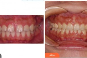 成都華西牙種植醫(yī)院劉果生整形價(jià)格表附牙齒正畸案例展示